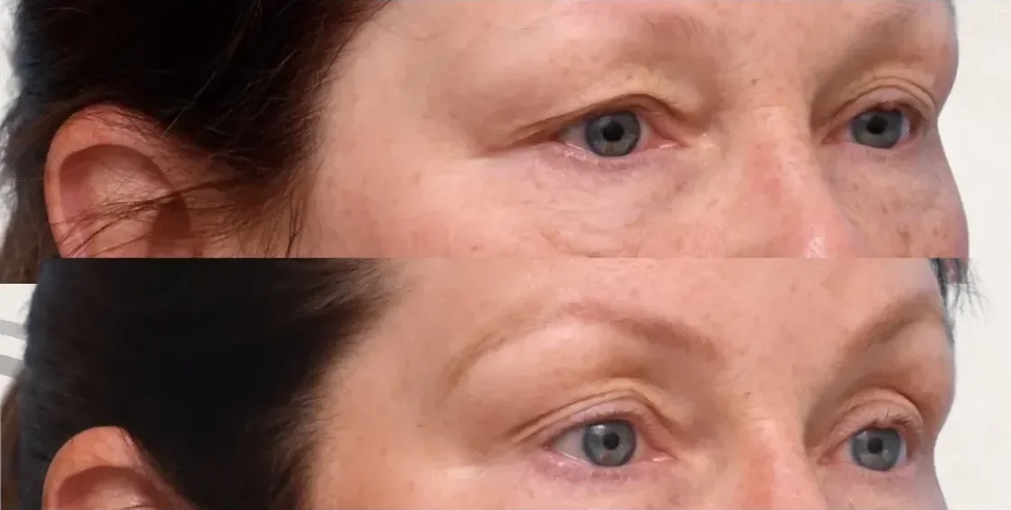 Botox Antifaz